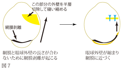 高度近視による黄斑円孔網膜剥離について　図3