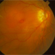 高度近視による黄斑円孔網膜剥離について
